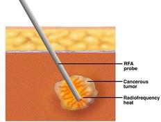 5 Key Advantages and disadvantages of Microwave Ablation
