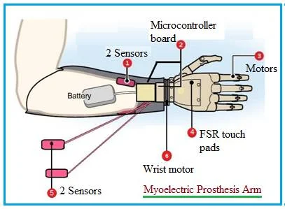 Myoelectric Prosthesis Arm